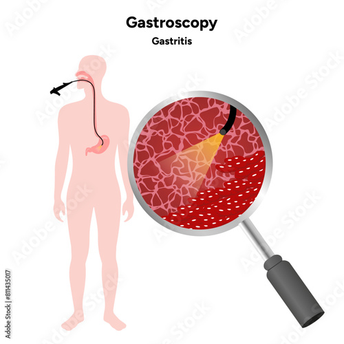 Gastroscopy procedure, gastritis with endoscope. Medical diagram infographic 