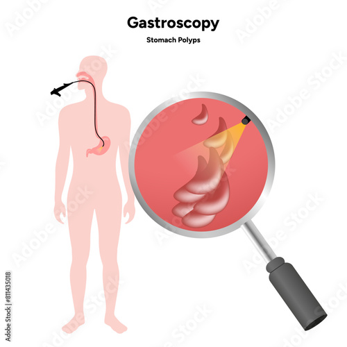 Gastroscopy, stomach polyps 