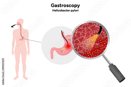 Gastroscopy procedure, helicobacter pylori