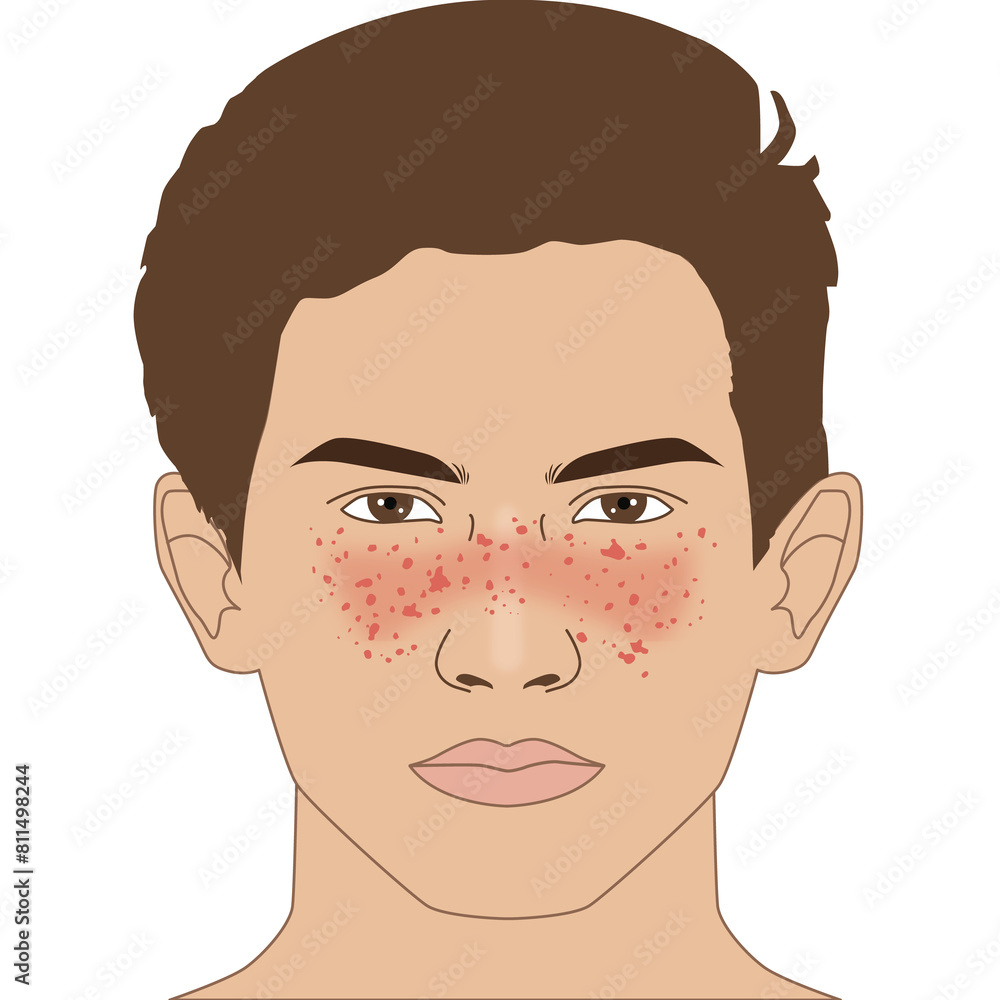 Butterfly autoimmune symptoms of SLE on the nose and cheeks's man, illustration on white background Butterfly autoimmune symptoms of SLE on the nose and cheeks's man, illustration on white background