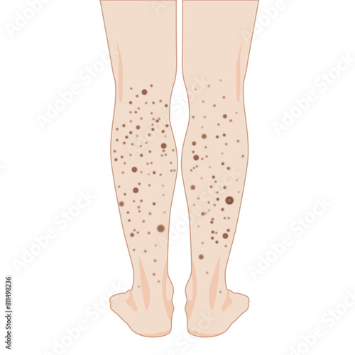 Man's legs with many small dots lesion from mosquito bite or allergy rash or atopic, illustration on white background