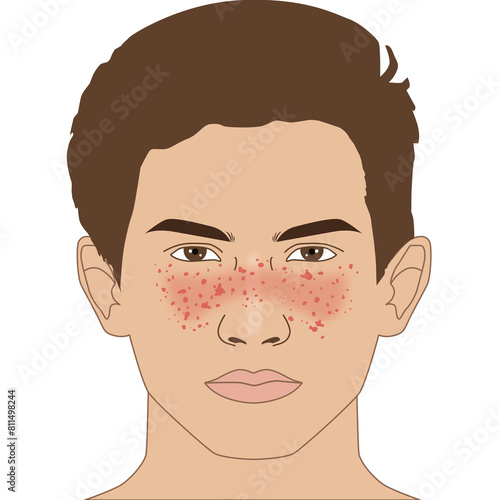 Butterfly autoimmune symptoms of SLE on the nose and cheeks's man, illustration on white background