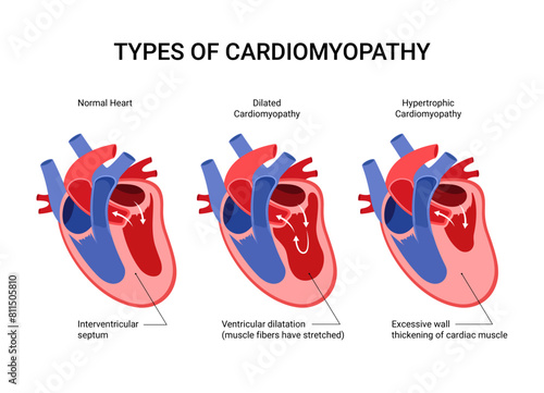 Medical design diagram for types cardiomyopathies