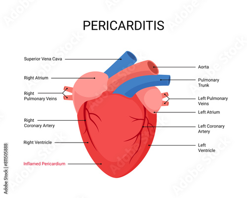 Diagram of human heart with pericarditis disease photo