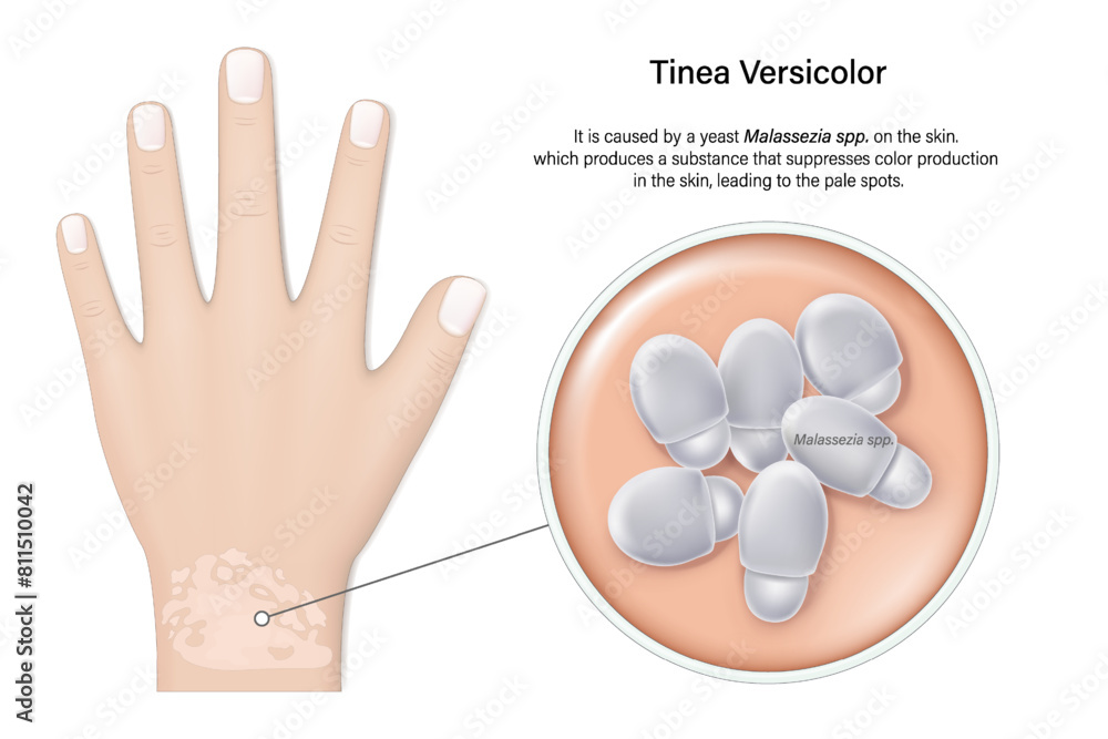 Tinea versicolor. Pityriasis versicolor is a common fungal infection of ...