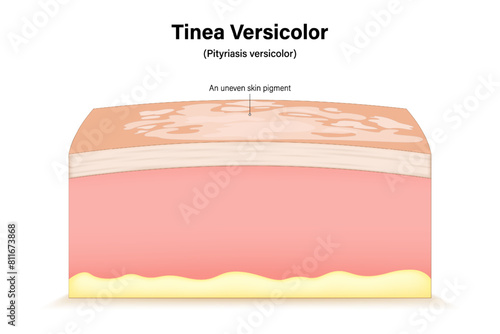 Tinea versicolor. Pityriasis versicolor. Fungal skin infection. Cross section of a human skin with Malassezia grows rapidly on the surface of the skin. photo