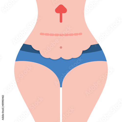 Abdominoplasty Icon