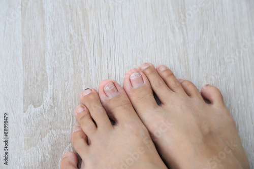 unhealthy nail at foot for health care concept for good living life