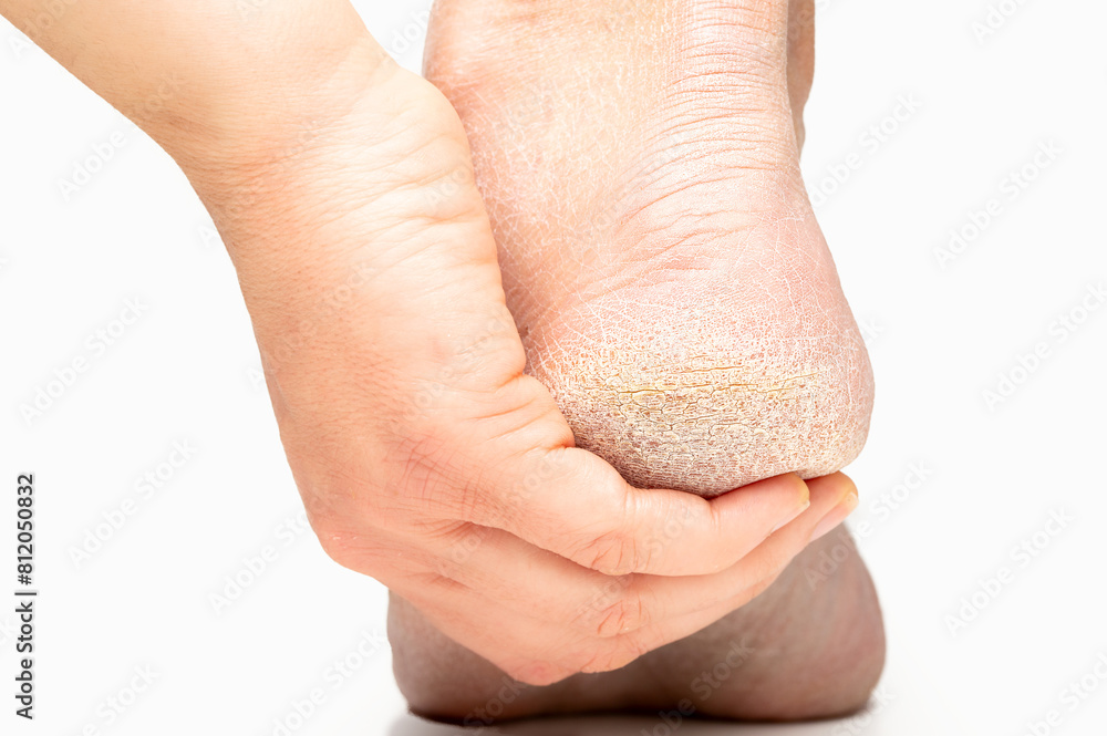 Φωτογραφία Closeup of female heel with hardened skin.