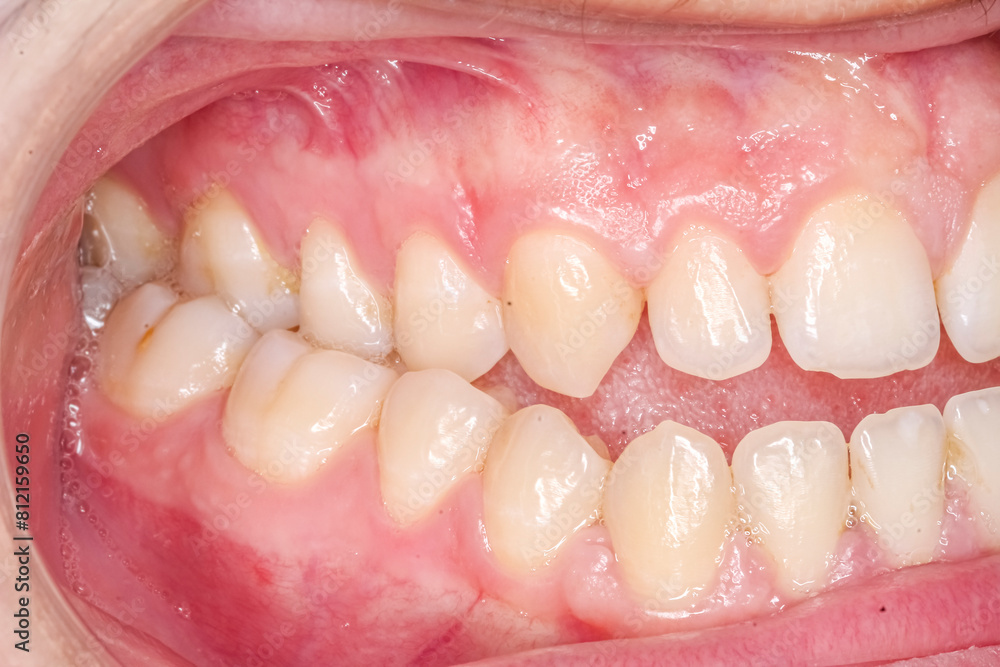 Obraz premium Lateral oblique view of dental maxillary and mandibular arches in occlusion with crooked teeth in articulated cross and open bite, cheeks and lips retracted with cheek retractor. Healthy gingival gum.