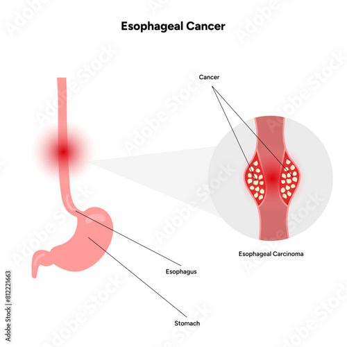 Esophageal cancer disease malignant cancer cells form in the tissues of the esophagus