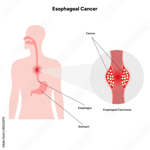 Esophageal cancer