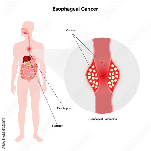 Esophageal cancer disease malignant cancer cells form in the tissues of the esophagus