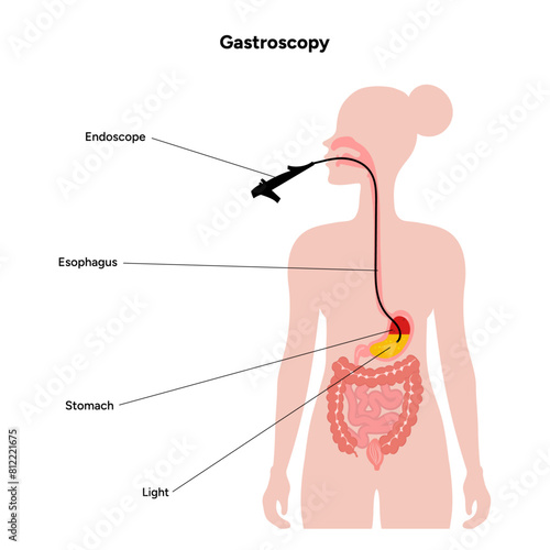 Gastroenterology concept, gastroscopy. Gastroscopy procedure, gastritis with endoscope. Medical diagram infographic 