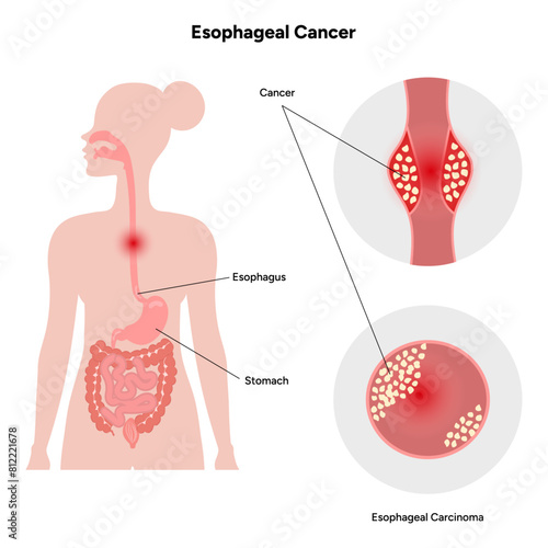 Esophageal cancer
