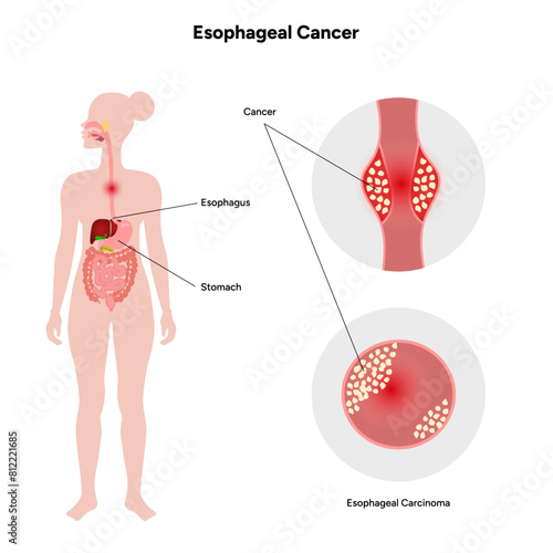 Esophageal cancer disease malignant cancer cells form in the tissues of the esophagus