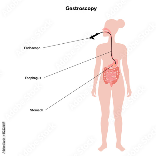 Gastroenterology concept, gastroscopy. Gastroscopy procedure, gastritis with endoscope. Medical diagram infographic 
