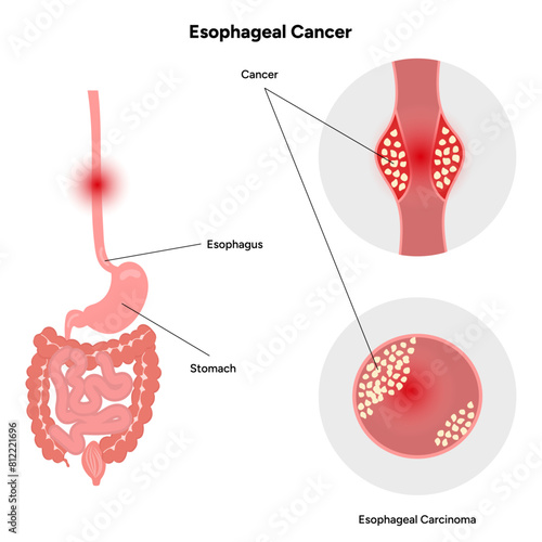 Esophageal cancer
