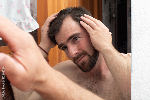 Photos worried man looking his hair loss on the mirror, young guy beginning alopecia pr