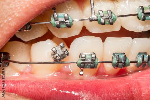 broken braces or wire breaks missing