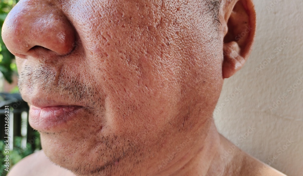 Fototapeta premium Portrait showing the wrinkle and Flabby skin, rash and allergy, blackhead and acne, hives and reaction, dark spots and blemish, freckles and loose on the Face, health care and medical concept.