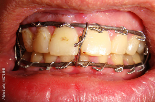 Slika na platnu Metal plate of the upper jaw and lower sled after surgical intervention of defor