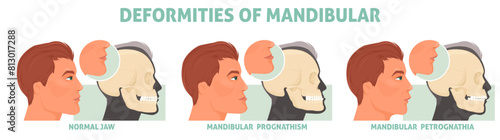 Deformities of mandibular with normal jaw, prognathism and petrognathia symptom medical poster vector illustration. Cranio defects, facial cosmetic disorder