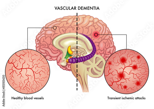 Medical illustration compares healthy blood vessels of the brain, with others affected by transient ischemic attacks which are one of the causes of vascular dementia in the brain.