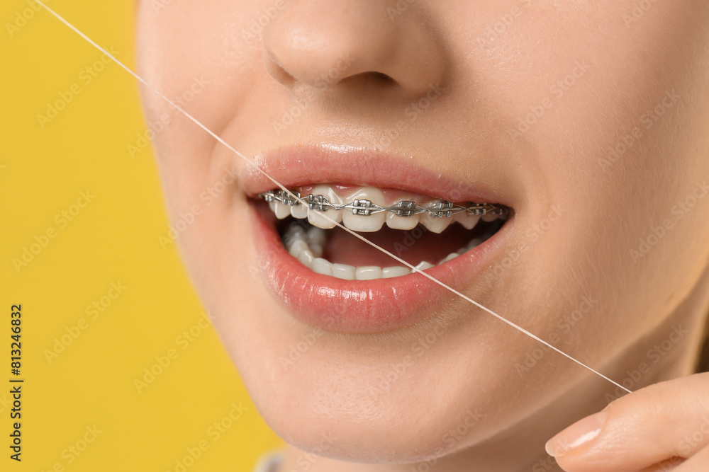 Obraz premium Woman with braces cleaning teeth using dental floss on yellow background, closeup