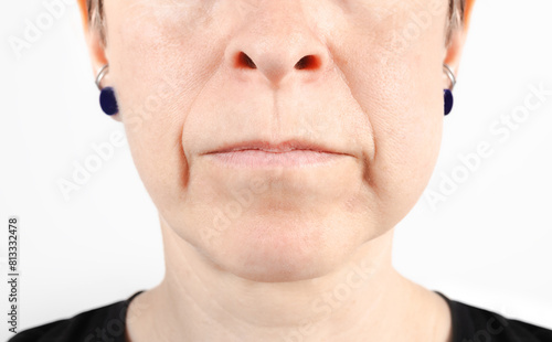 Swollen cheek from wisdom tooth extraction on day 3. Close up of woman with swollen face. Cheek swelling from dental surgery, wisdom teeth removal or tooth infection concept. Selective focus. photo