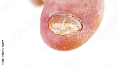 Fungal infection of nails feet close-up. Infected toes with fungus and unpleasant odor. White man's sore feet. Hygiene and health care. 
Toenails with fungal infection. Onychomycosis. 