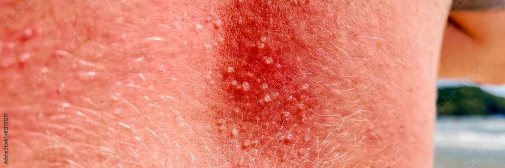Close-up of a person with sunburnt neck wearing green swim shorts at the beach, depicting summer vacations and the importance of sun protection Close-up of a person with sunburnt neck wearing green swim shorts at the beach, depicting summer vacations and the importance of sun protection