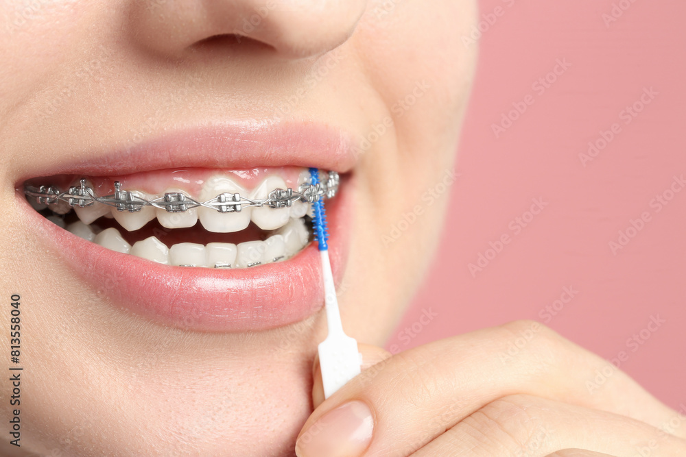 Fototapeta premium Smiling woman with dental braces cleaning teeth using interdental brush on pink background, closeup