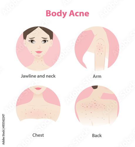 Acne on face and body woman vector icon set on white background. Pimples, blackheads, comedones, whiteheads, papule, pustule, nodule, cyst on jawline, neck, arm, chest and back. Skin problem concept.