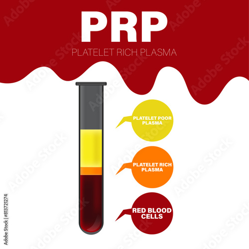 Vector illustration of test tube filled with blood after centrifugation of whole blood for PRP therapy vector illustration.