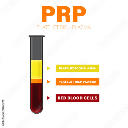 Vector illustration of test tube filled with blood after centrifugation of whole blood for PRP therapy.