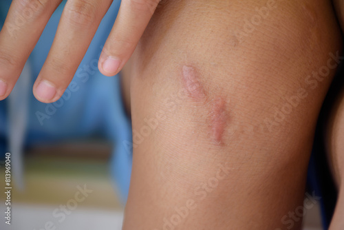 Scar is inflamed and red called keloids on children knee close-up in body parts blurred background concept of skin and wound for medical healthy skin care.