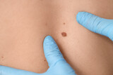 Dermatologist examining moles on young woman in clinic, closeup