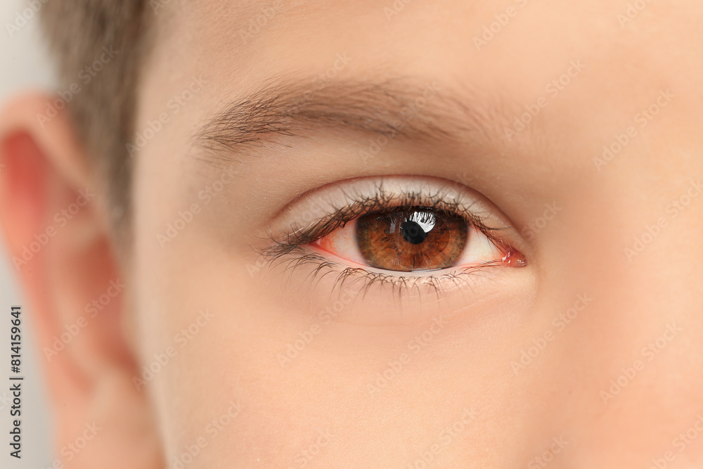 Obraz premium Little child suffering from conjunctivitis, closeup view