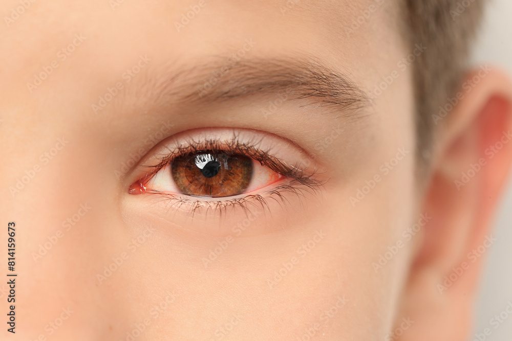 Little child suffering from conjunctivitis, closeup view Little child suffering from conjunctivitis, closeup view