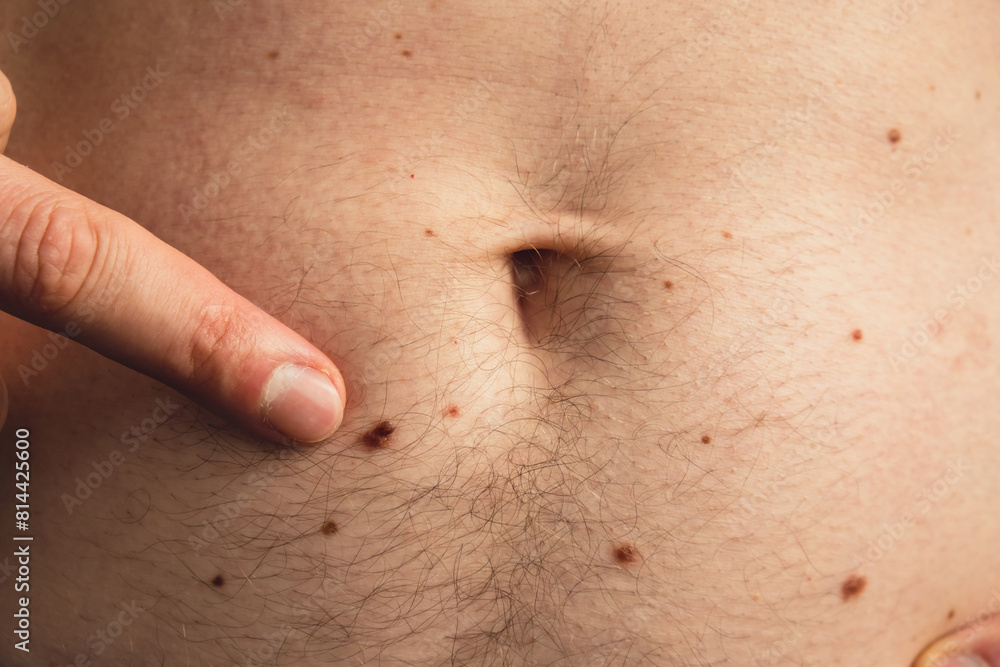 Fototapeta premium Unrecognizable man showing his birthmarks on skin Close up detail of the bare skin Sun Exposure effect on skin. Health Effects of UV Radiation Male with birthmarks Pigmentation and lot of birthmarks