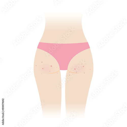 Acne on woman buttocks vector illustration isolated on white background. Pimples, comedone, papule, pustule, nodule and cyst on the bottom, hip, ass of woman body. Skin care and skin problem concept.