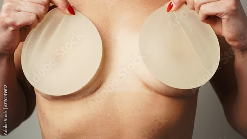 Surgical Journey: Woman Displays Removed Breast Implants photo