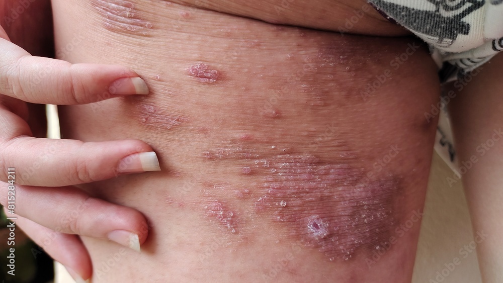 Fototapeta premium close up the rash hives allergy, allergic and reaction, scar and acne, irritated and wound on the leg, health care and medical concept.
