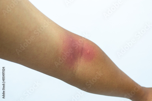 Obraz na plátně Insect bite on human skin