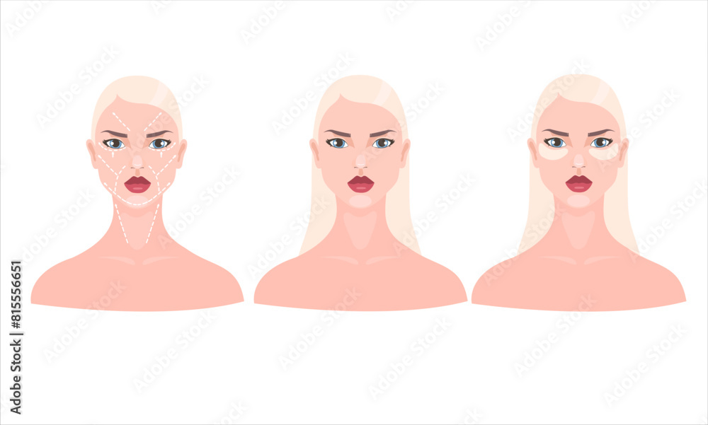 Vector of three blonde women with fuller lips: one with pre-facelift markings, another with a bare face, and the third with beauty patches Vector of three blonde women with fuller lips: one with pre-facelift markings, another with a bare face, and the third with beauty patches