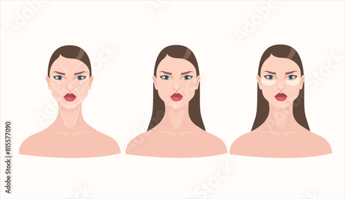 Tableau sur toile Vector featuring portraits of three brunette women with enhanced lips: one with face-lift markings, one with a clear face, and one with facial patches