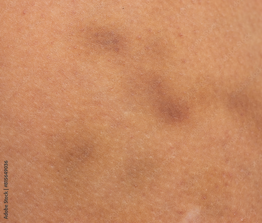 blue bruise on the skin of the arm.