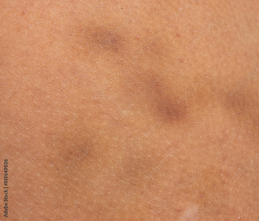 blue bruise on the skin of the arm. blue bruise on the skin of the arm.