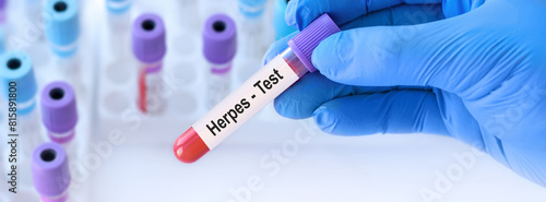 Doctor holding a test blood sample tube with herpes virus test on the background of medical test tubes with analyzes. Banner photo